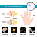 Parkinson`s disease Infographic. Symptoms of a parkinsonism