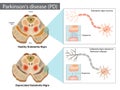 Parkinson s disease. Normal and Depreciated Substantia Nigra Royalty Free Stock Photo