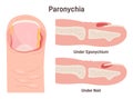 Paronychia. Nail disease, inflammation of the skin around the nail.