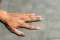 Paronychia, swollen finger with fingernail bed inflammation due to bacterial infection on a toddlers hand. Royalty Free Stock Photo