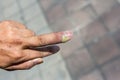 Paronychia, swollen finger with fingernail bed inflammation due to bacterial infection on a toddlers hand Royalty Free Stock Photo