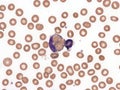 Paroxysmal cold hemoglobinuria.