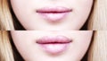 Part of face, young woman close up. plump lips after filler injection. Royalty Free Stock Photo