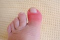 part of female foot, inflamed toe, inflammation joints foot due to arthritis, bruising, fracture of bones limb, concept of