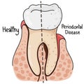 Healthy Teeth and Periodontal Disease. Royalty Free Stock Photo