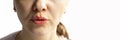 Part of a young woman face with red bubbles of virus herpes on lips Medicine, treatment. Long horizontal banner with Royalty Free Stock Photo