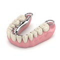 Partial denture with metal framework and acrylic base Royalty Free Stock Photo