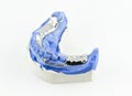 Partial Denture on white background Royalty Free Stock Photo