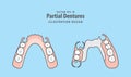 Partial Dentures illustration vector on blue background. Dental Royalty Free Stock Photo