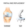 Partial knee replacement. Royalty Free Stock Photo