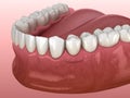 Partial removable immediate-denture type Butterfly. Replacement of one missing tooth 3D illustration Royalty Free Stock Photo