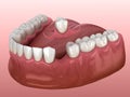 Partial removable immediate-denture type Butterfly. Replacement of one missing tooth 3D illustration