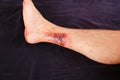 Partial thickness or third-degree burn on the leg Royalty Free Stock Photo