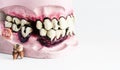 Partial wooden dentures and real tooth with caries and cavities on white background with copy space. Dental Health care