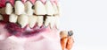 Partial wooden dentures and real tooth with caries and cavities on white background with copy space. Dental Health care