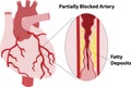 Partially Blocked Coronary Artery Royalty Free Stock Photo