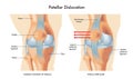 Patellar dislocation