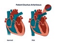 Patent ductus arteriosus with normal heart anatomy. Illustration of the congenital heart anomaly