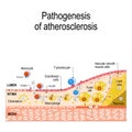 Pathogenesis of atherosclerosis