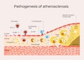 Pathogenesis of atherosclerosis medical illustration poster Royalty Free Stock Photo