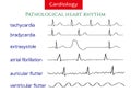 Pathological ecg collection. Royalty Free Stock Photo