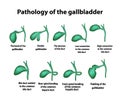 Pathology of the gallbladder. The bend of the gallbladder. Set.