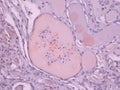 Pathology of Kidney Glomerulus