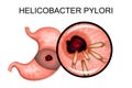 Pathology of the stomach. Helicobacter pylori Royalty Free Stock Photo