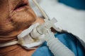 Patient do tracheostomy and ventilator in hospital