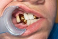 Patient with bad metal dental crowns close-up. The concept of treatment and restoration of aesthetics in the dental clinic Royalty Free Stock Photo