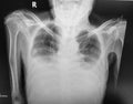 Patient is bilateral pleural effusion