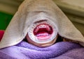 Patient with braces and a cheek retractor in a dental clinic