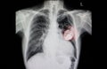 patient with cardiac pacemaker