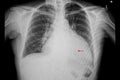 A patient with cardiomegaly