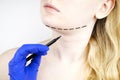 Mentoplasty: plastic chin. Patient before chin and neck surgery. Plastic surgeon advises