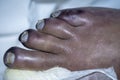 Gangrenous foot on a Male Patient