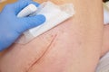 Patient with fresh long scar on hip lay in hospital bad. Nurse hand clear the skin.