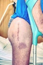 Patient with a fresh long scar after a hip surgery. Macro, Human leg