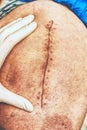 Patient with a fresh long scar after a hip surgery. Macro, Human leg