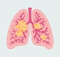 Patient-friendly scheme of Lung Cancer. Anatomical Diagram of tumor and metastasis in respiratory organs