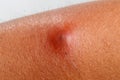 The patient had an abscess on his arm. Royalty Free Stock Photo
