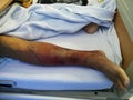 A patient hospitalized on bed and resting with leg injury background.