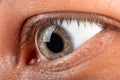 Patient with keratokonus eye closeup, corneal dystrophy diagnosis