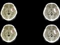 a patient with a large hematoma in the brain