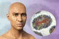 Patient with monkeypox and close-up view of monkeypox virus, 3D illustration Royalty Free Stock Photo