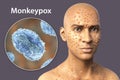 Patient with monkeypox and close-up view of monkeypox virus, 3D illustration Royalty Free Stock Photo