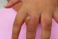 Patient`s hand and thumb with heat blisters and injuries.from scalded hot water Royalty Free Stock Photo