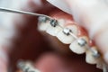 Patient`s open mouth at the dentist`s appointment. Braces maintenance procedure