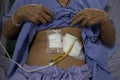 Patient show tube on stomach for feeding food