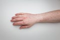 Patient shows arm and hand with red itchy painful rash. Allergic symptom on male hands. Dermatology, skin care. White background,